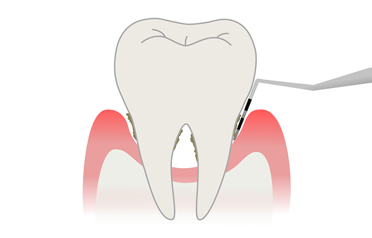 歯周ポケットの深さと歯周病の目安
