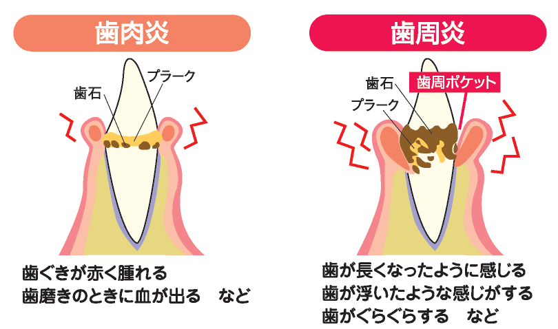 歯肉炎と歯周炎の違い